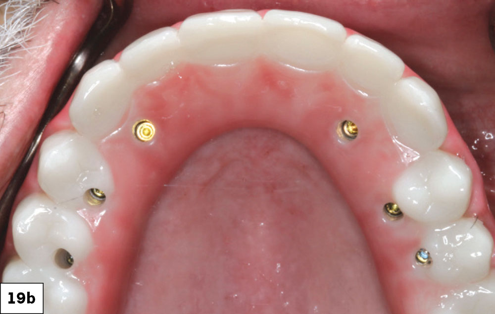 The BruxZir implant-retained prosthesis was threaded into place.