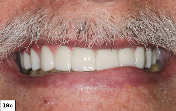 The BruxZir implant-retained prosthesis was threaded into place.