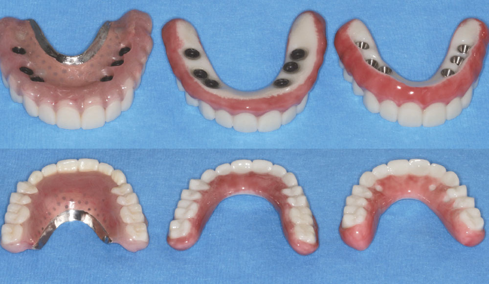 Full-arch prosthetic options are shown. From left to right: Maxillary Locator Overdenture, Locator Fixed Prosthesis and screw- retained full-arch prosthesis