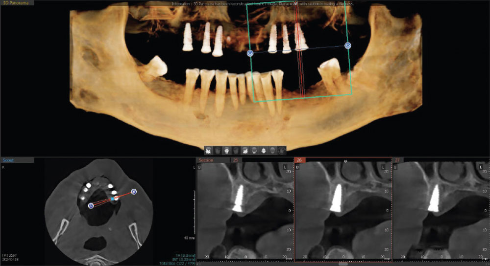 Postoperative CT illustrating position of the six implants anterior to the maxillary sinuses