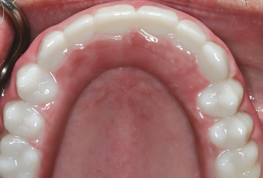 The palate was relieved and the patient maintained this fixed prosthesis.
