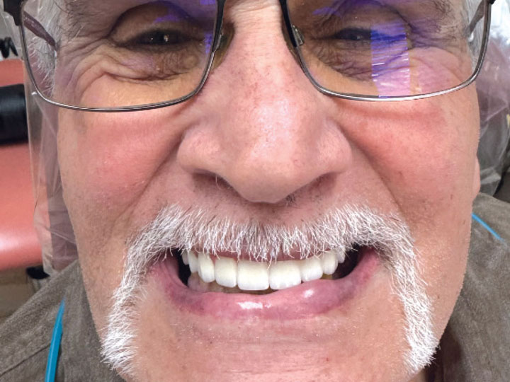 The final BruxZir implant-retained prosthesis was happily accepted by the patient