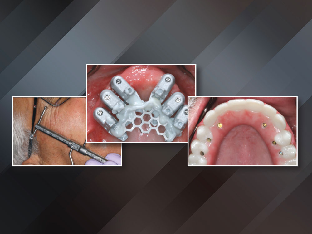 Treatment Options for the Edentulous Arch