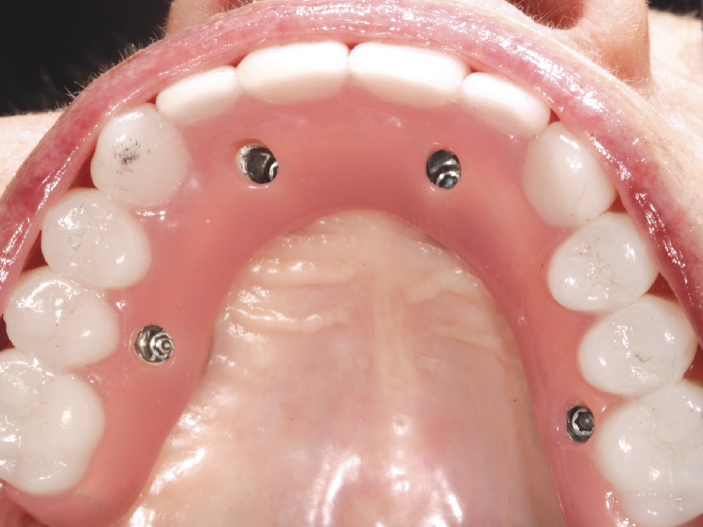 This intraoral view of a maxillary All-on-4 hybrid denture illustrates access openings for screw retention.