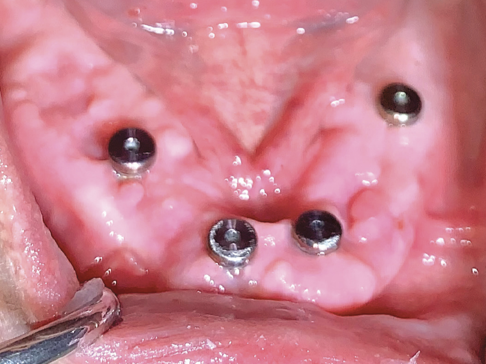 Healing abutments were removed four months after implant placement in order to select and place the appropriate Locator Abutments.