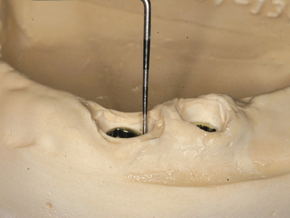 The gingival sulcus depth was measured at each implant site with a perio probe to determine the correct Locator Abutment height for use.