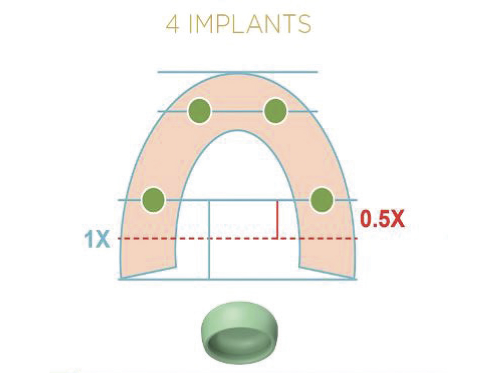 Green Locator Fixed Attachments are used in all sites for four-implant cases.
