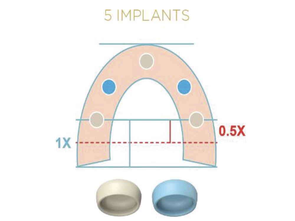 A combination of blue and tan Locator Fixed Attachments is recommended for sites for five- or six-implant cases.