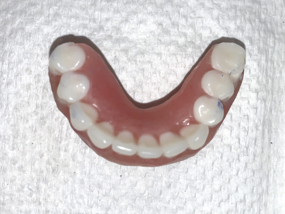 Occlusal view of the conversion of the original denture to an attachment-retained Locator Fixed appliance.