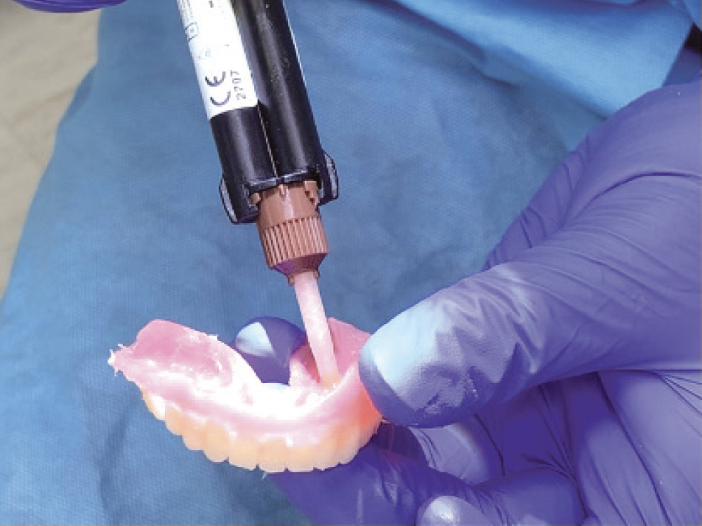 Locator Chairside Attachment Processing Material (Zest IP Holdings, LLC), which is a dual-cure methyl methacrylate base material, was injected into each denture access opening for the metal housing and attachment pickup procedure.