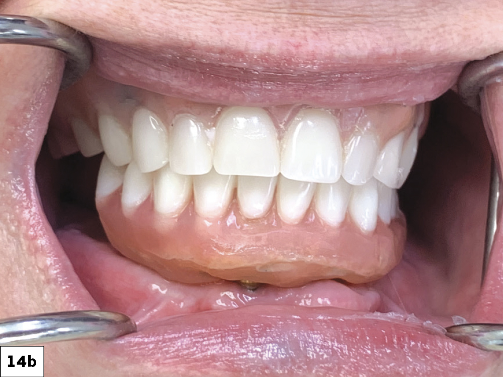 The completed Locator Fixed Prosthesis exhibits excellent stability during function (a). The completed Locator Fixed Prosthesis in occlusion (b). Panoramic X-ray of the seated mandibular prosthesis (c). The patient expressed her intention to address the maxillary arch at a later date.
