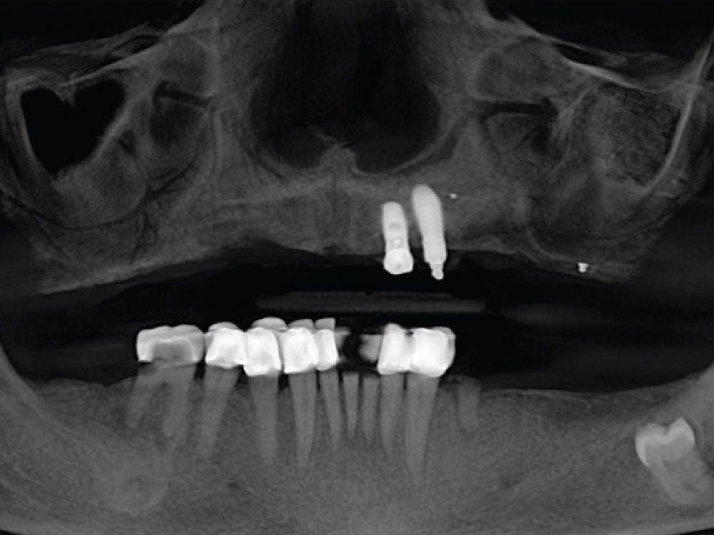 This preoperative X-ray shows the terminal mandibular dentition and a maxillary overdenture retained by two implants