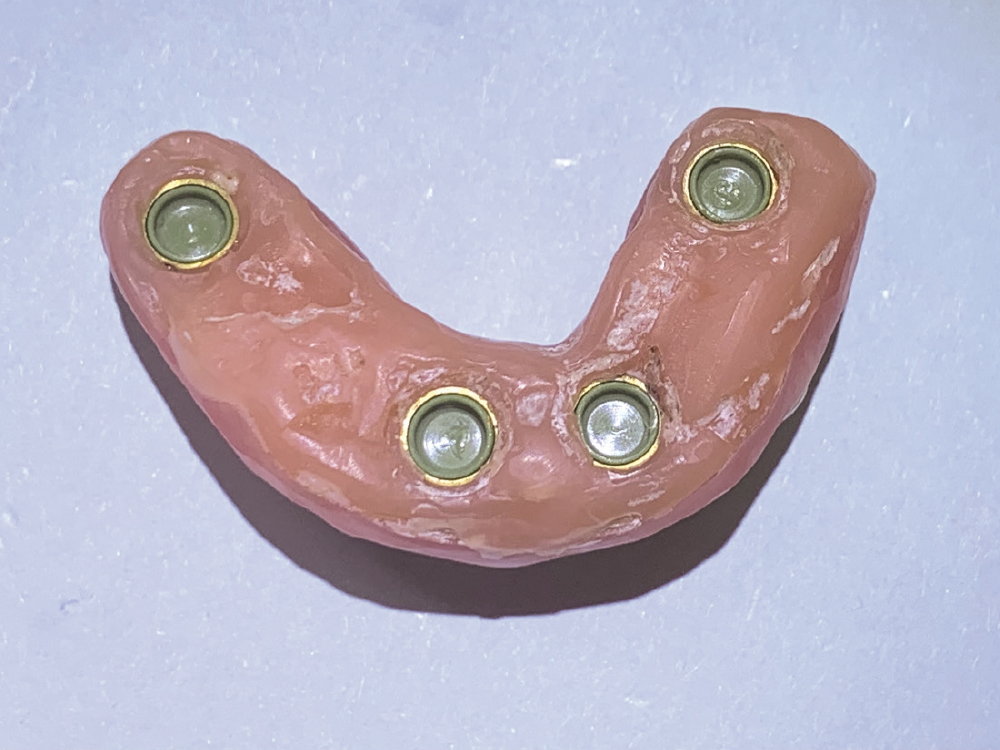 Green Locator Fixed attachments replaced black processing attachments following the protocol for a four-implant Locator Fixed case.