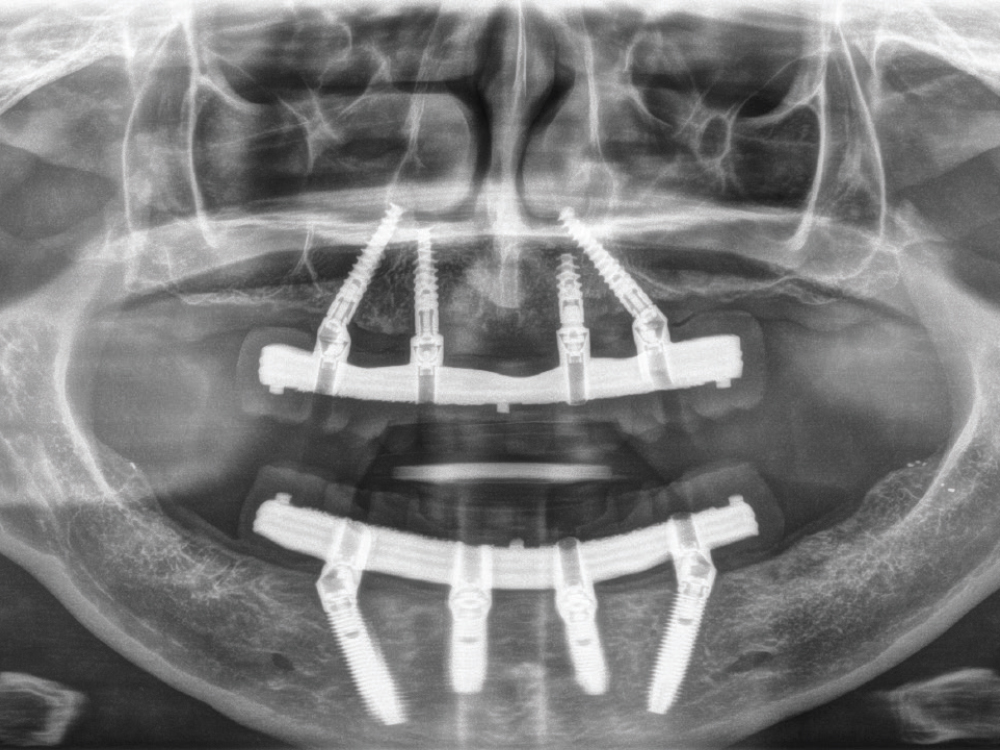 This panoramic X-ray shows traditional maxillary and mandibular All-on-4® hybrid prostheses with milled titanium bars supporting a screw-retained hybrid denture.