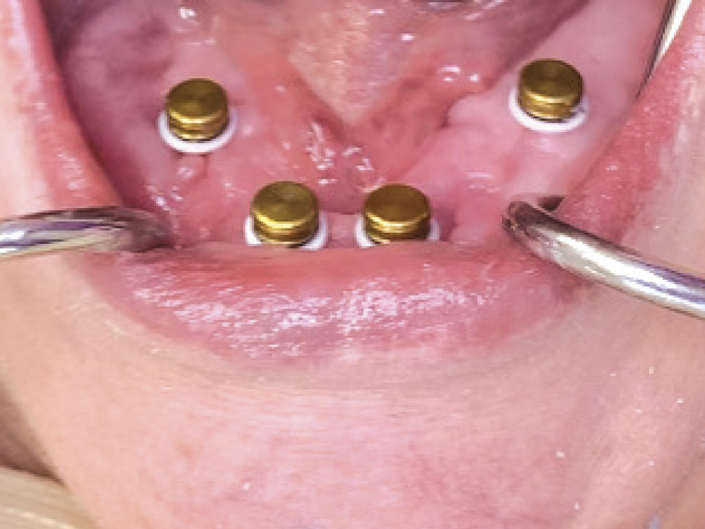 Metal housings with black attachments were snapped onto all the Locator Abutments. White blockout spacers were positioned apical to the housings.