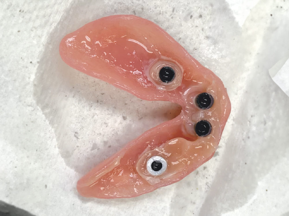 Black attachments with their metal housings were connected to the denture base from the pickup procedure. Voids were filled in with additional processing material.