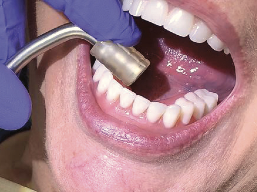 The Locator Fixed Seating Tool provided full seating of the attachments onto the Locator abutments.