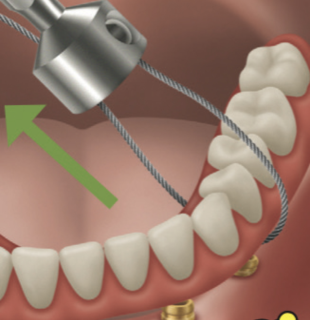 The removal tool lifts the appliance with a controlled force directed occlusally at each implant site.
