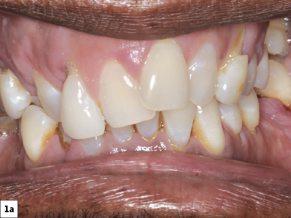 The desire for improved esthetics motivated the patient to seek consultation. A retracted view shows the patient’s anterior misalignment and malocclusion in the maxillary arch. CBCT analysis showed extensive periodontal bone loss that warranted extraction and implant reconstruction in the maxilla and posterior mandible.