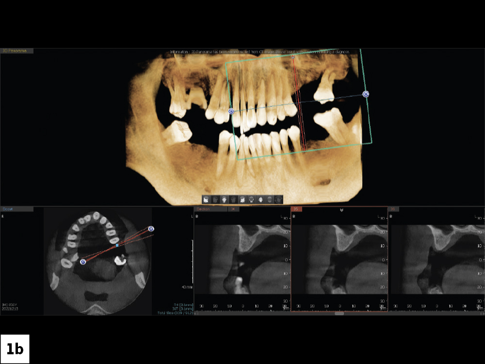 The desire for improved esthetics motivated the patient to seek consultation. A retracted view shows the patient’s anterior misalignment and malocclusion in the maxillary arch. CBCT analysis showed extensive periodontal bone loss that warranted extraction and implant reconstruction in the maxilla and posterior mandible.