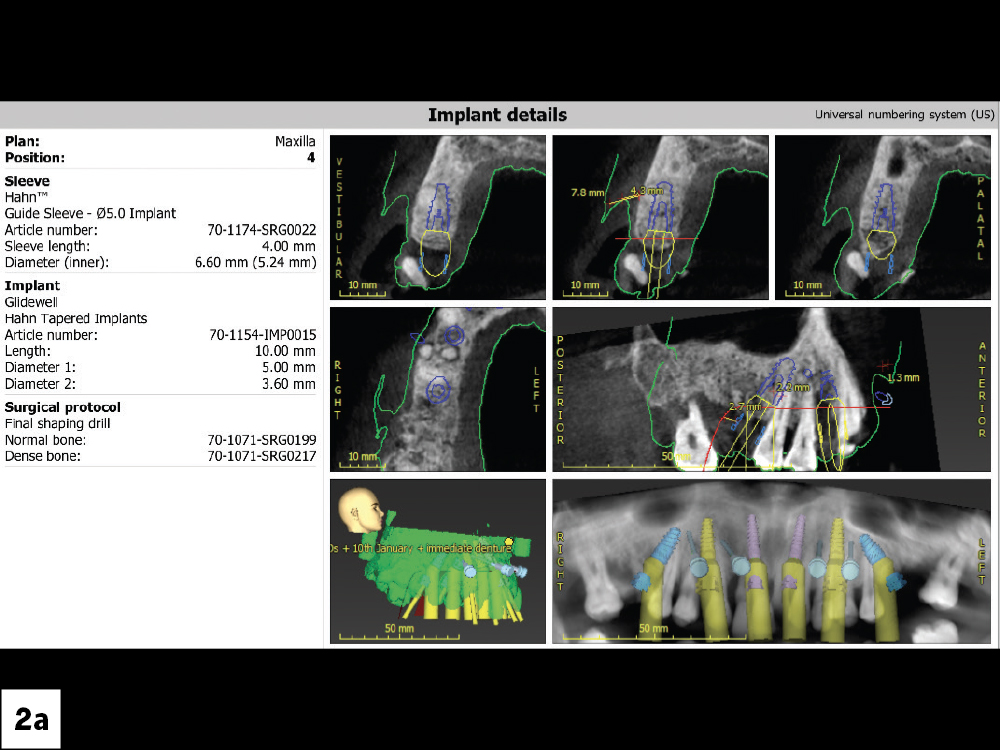 After reviewing the patient’s health history and finding no contraindications to the treatment plan, the next step was evaluating the bone volume available to support the implants.