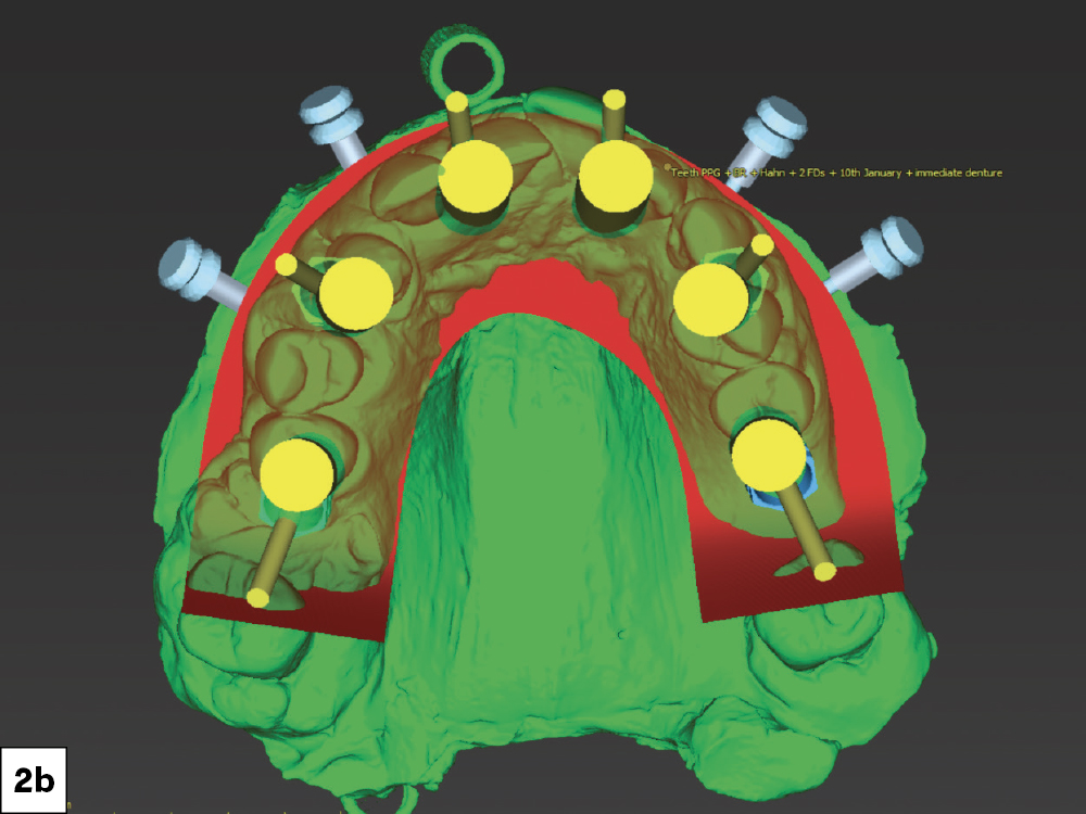 The case was planned preoperatively through the digital treatment planning (DTP) process, working with the DTP team at Glidewell.