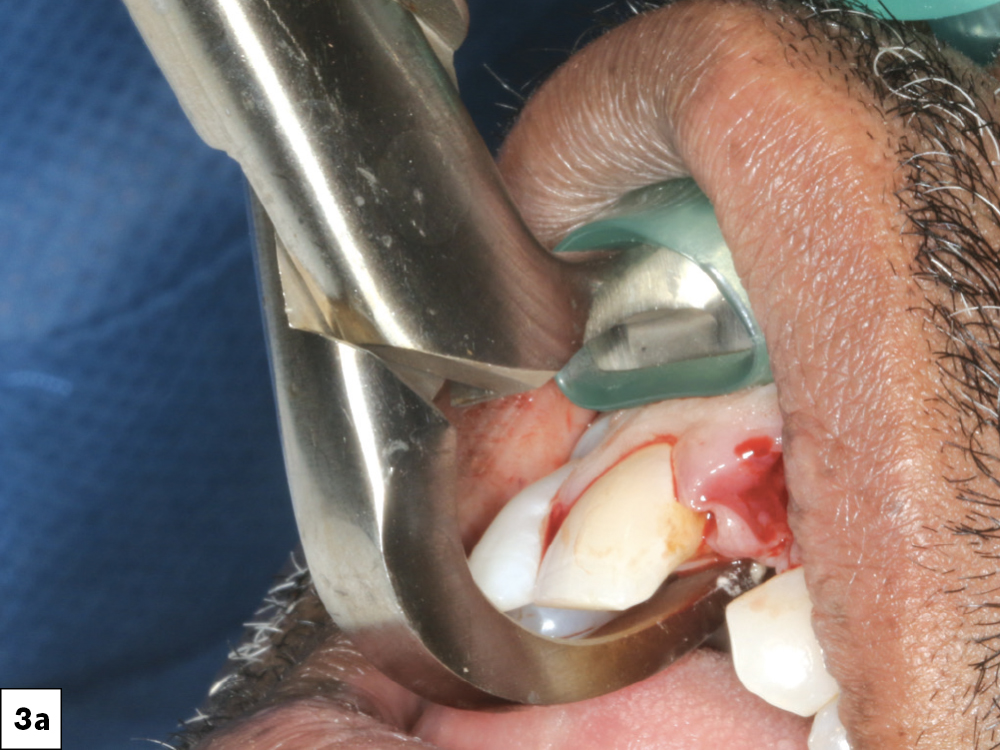 I extracted the hopeless and compromised teeth, with minimal trauma in order to maintain the facial plate.