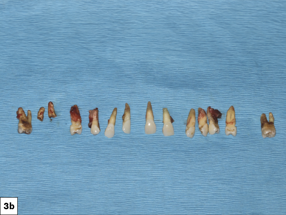 I extracted the hopeless and compromised teeth, with minimal trauma in order to maintain the facial plate.