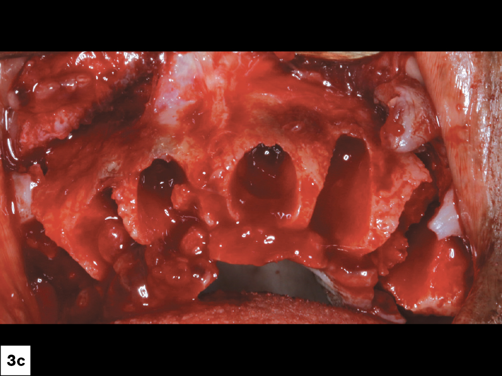 I extracted the hopeless and compromised teeth, with minimal trauma in order to maintain the facial plate.