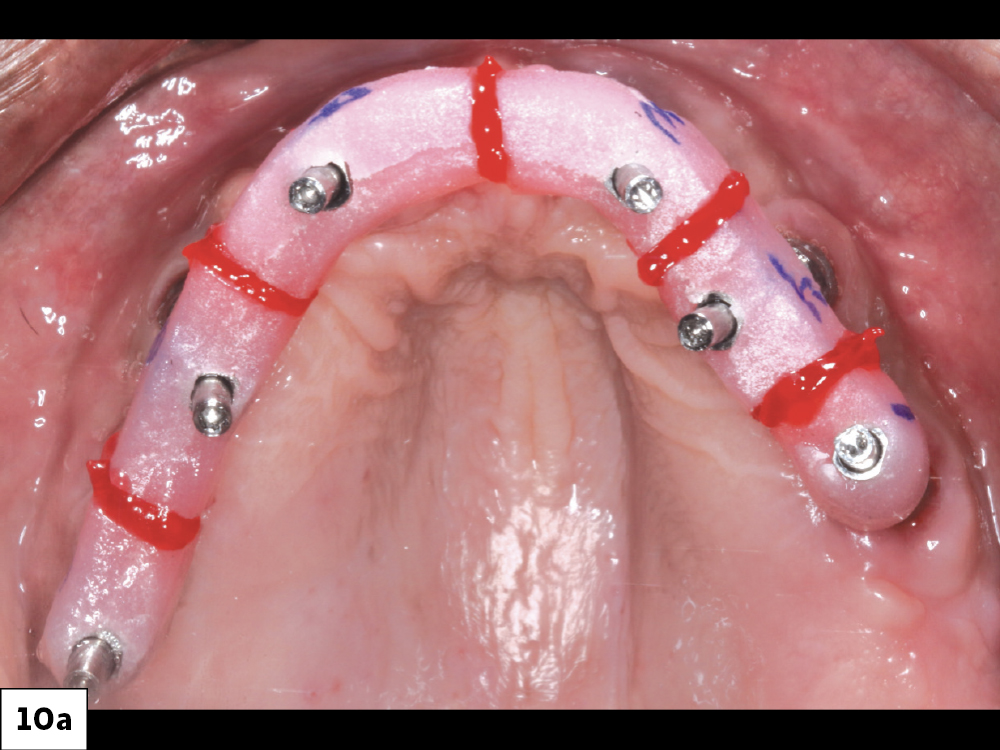 The implant verification jig (IVJ) process helps ensure the accuracy of the master model. After luting the individual pieces of the IVJ together intraorally, I picked them up in the final impression. The provisional as well as the final full-arch BruxZir® Implant Prosthesis used this master cast for fabrication.