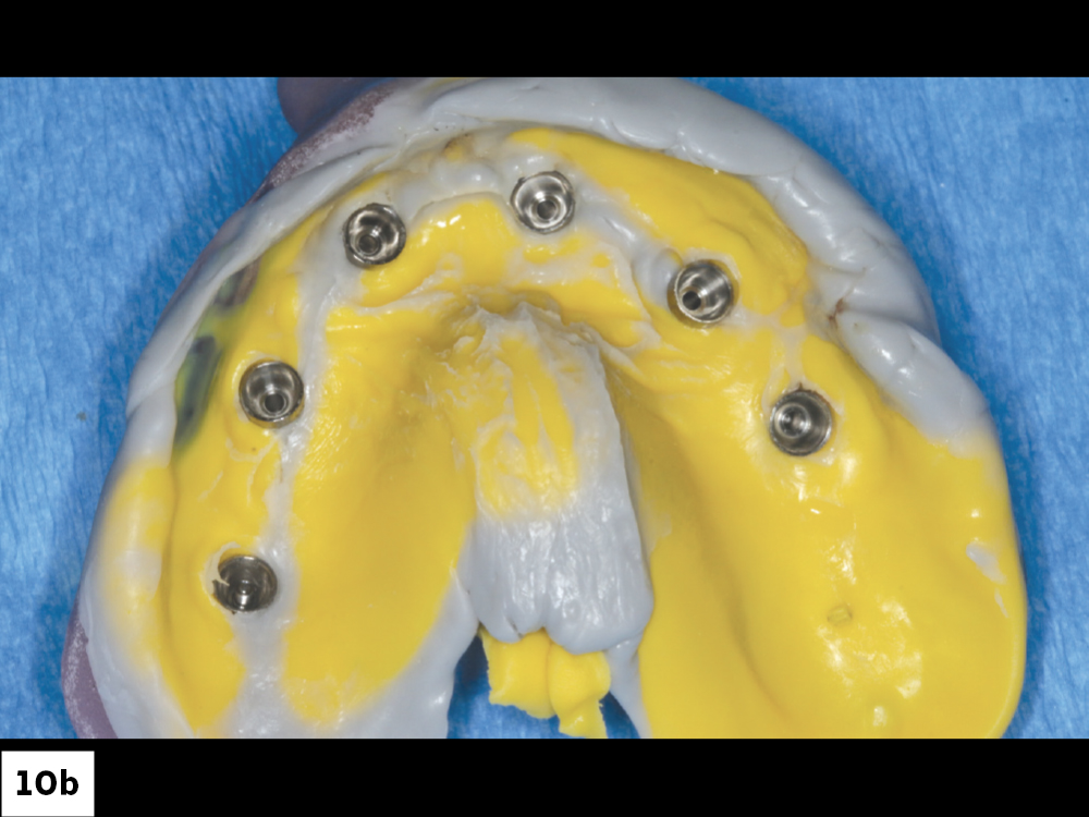 The implant verification jig (IVJ) process helps ensure the accuracy of the master model. After luting the individual pieces of the IVJ together intraorally, I picked them up in the final impression. The provisional as well as the final full-arch BruxZir® Implant Prosthesis used this master cast for fabrication.