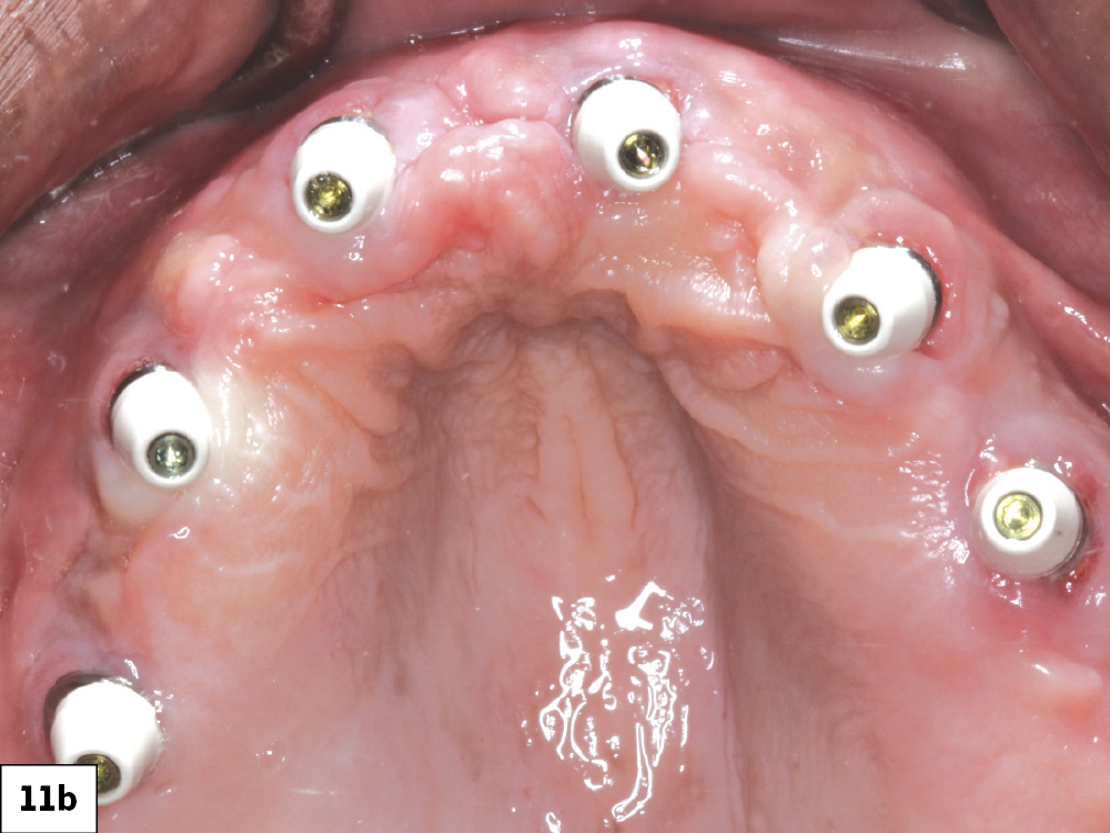 A wax rim was tried in and adjusted to determine the appropriate vertical dimension. I then threaded multiunit abutment (MUA) healing caps over the MUAs for the patient’s comfort and added retention of the transitional complete denture.
