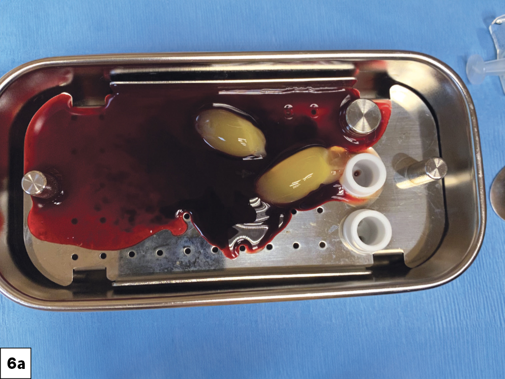 I used Newport Biologics™ allograft particulate (Glidewell Direct; Irvine, Calif.) to fill in facial defects and socket sites to prevent the invagination of epithelium.