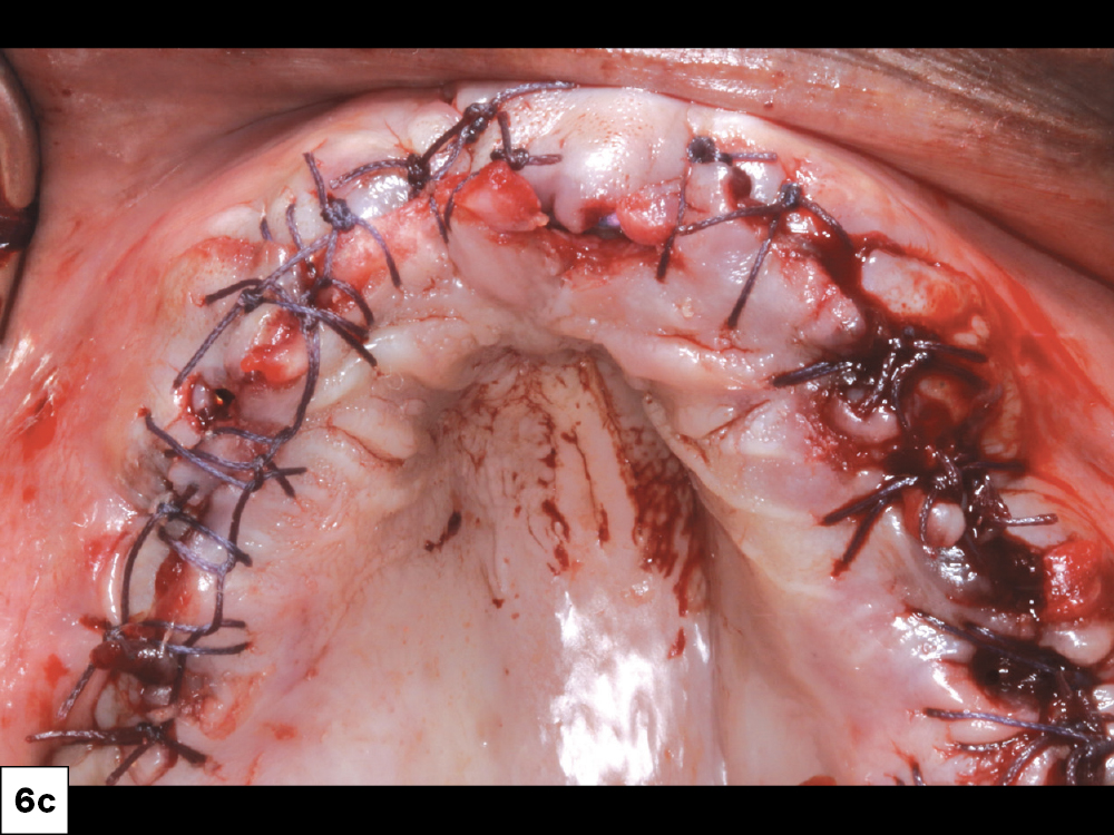 We used a plateletrich fibrin membrane to promote healing and bone regeneration. I closed the flap with continuous REDISORB PRO® sutures (available through Glidewell Direct).