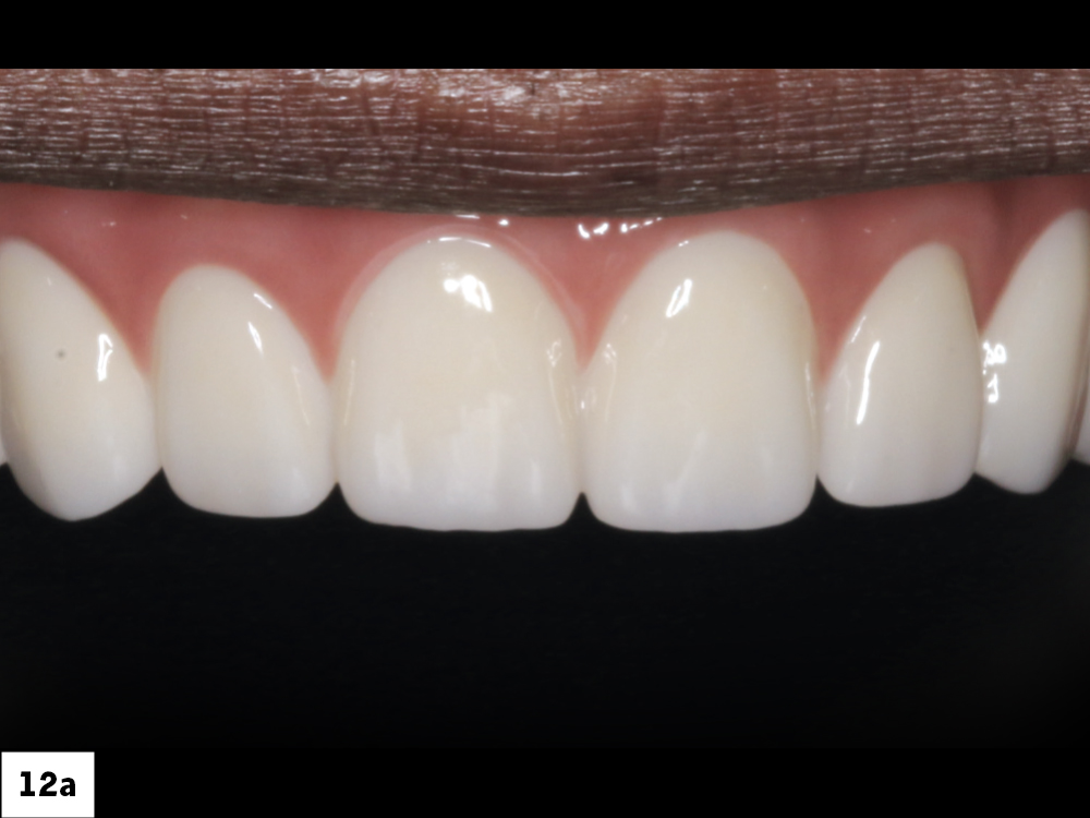 Once the first denture setups were tried in over the multi-unit abutments and approved, a polymethyl methacrylate (PMMA) provisional was milled. I then inserted this prosthesis and verified esthetics and function.