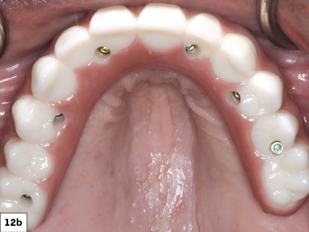 Once the first denture setups were tried in over the multi-unit abutments and approved, a polymethyl methacrylate (PMMA) provisional was milled. I then inserted this prosthesis and verified esthetics and function.