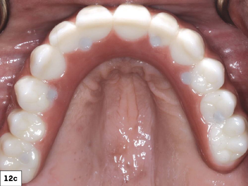 Once the first denture setups were tried in over the multi-unit abutments and approved, a polymethyl methacrylate (PMMA) provisional was milled. I then inserted this prosthesis and verified esthetics and function.
