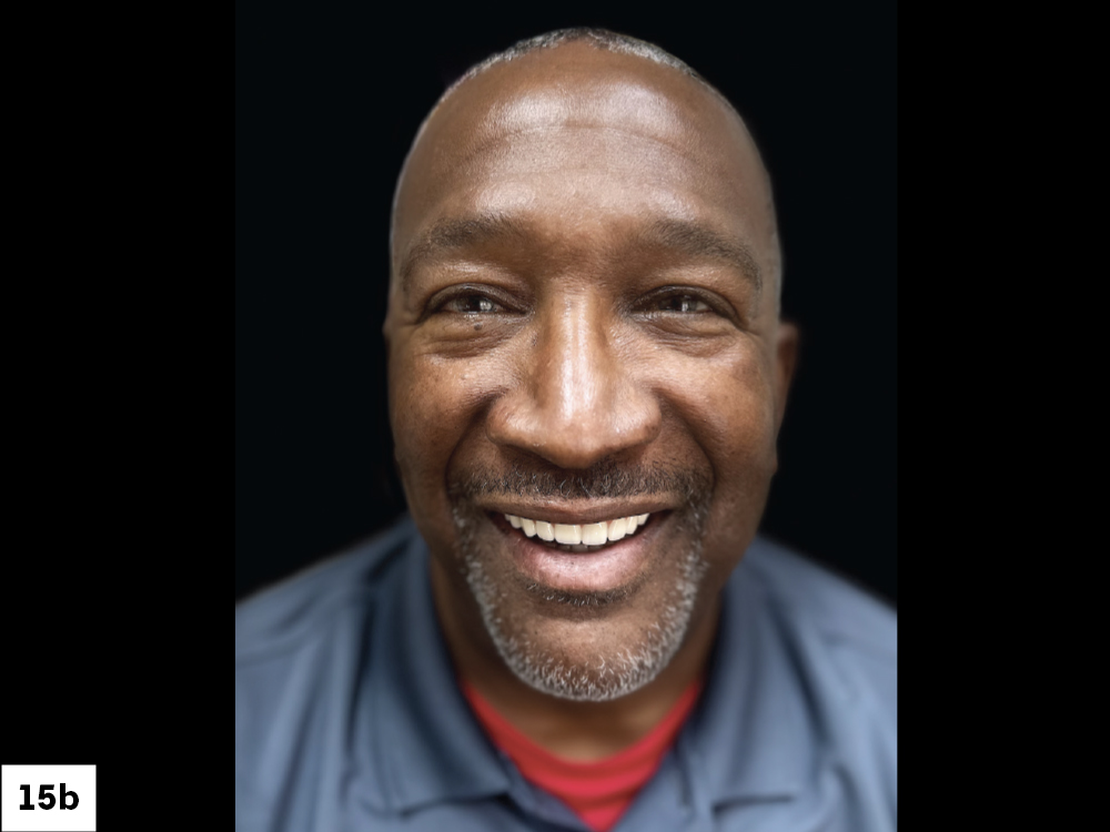 The full-arch implant restoration met the patient’s expectations for esthetics, form and function to improve his quality of life.