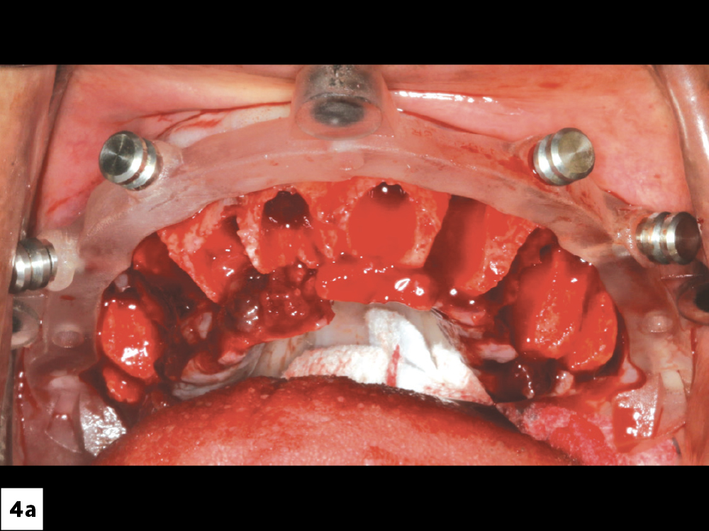 First, I positioned the foundation guide. Using the bone reduction guide, excess bone was reduced in order to level the surface and provide 14–16 mm of interocclusal space for the restoration.