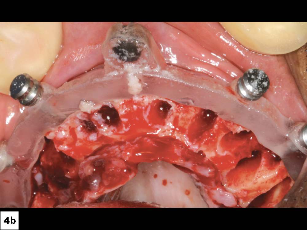 First, I positioned the foundation guide. Using the bone reduction guide, excess bone was reduced in order to level the surface and provide 14–16 mm of interocclusal space for the restoration.