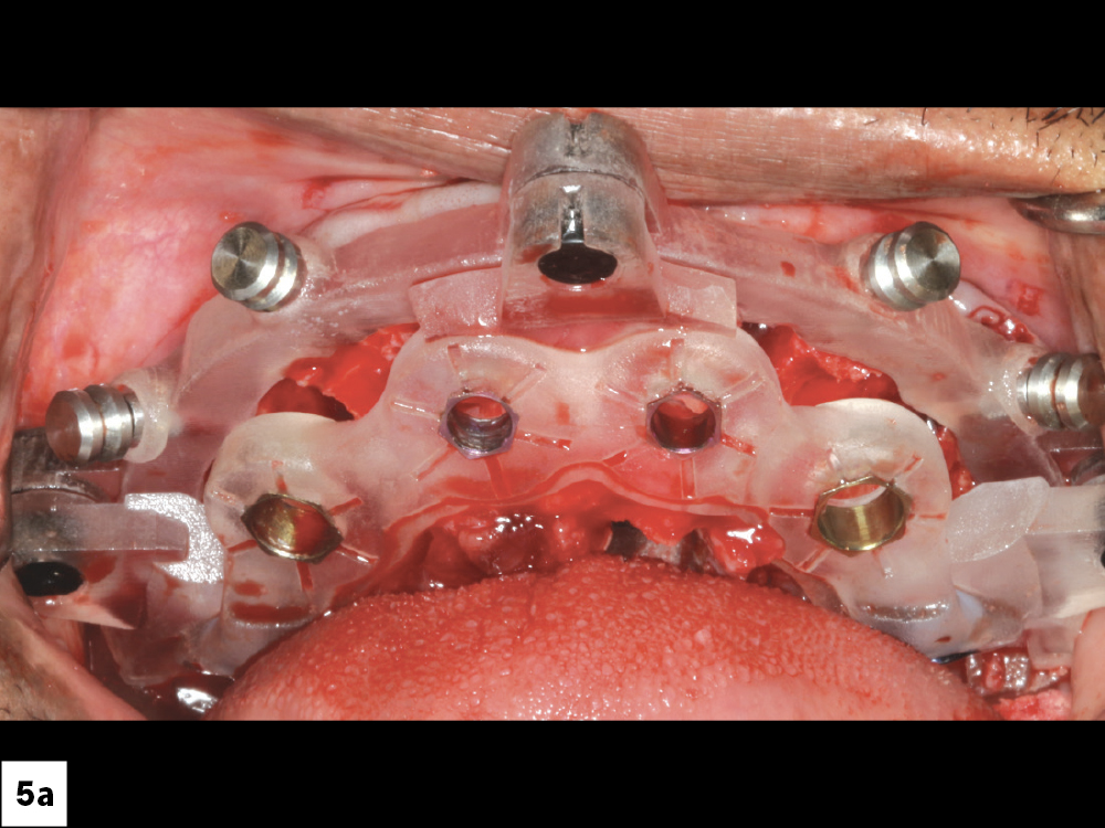 The osteotomy guide was then passively and completely seated, allowing for precise positioning of the implants.
