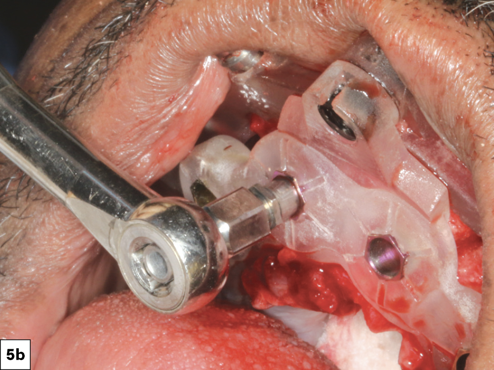 Implant sites were created using the sequential drills in the Glidewell HT™ Implant Guided Surgery System (Glidewell Direct; Irvine, Calif.).