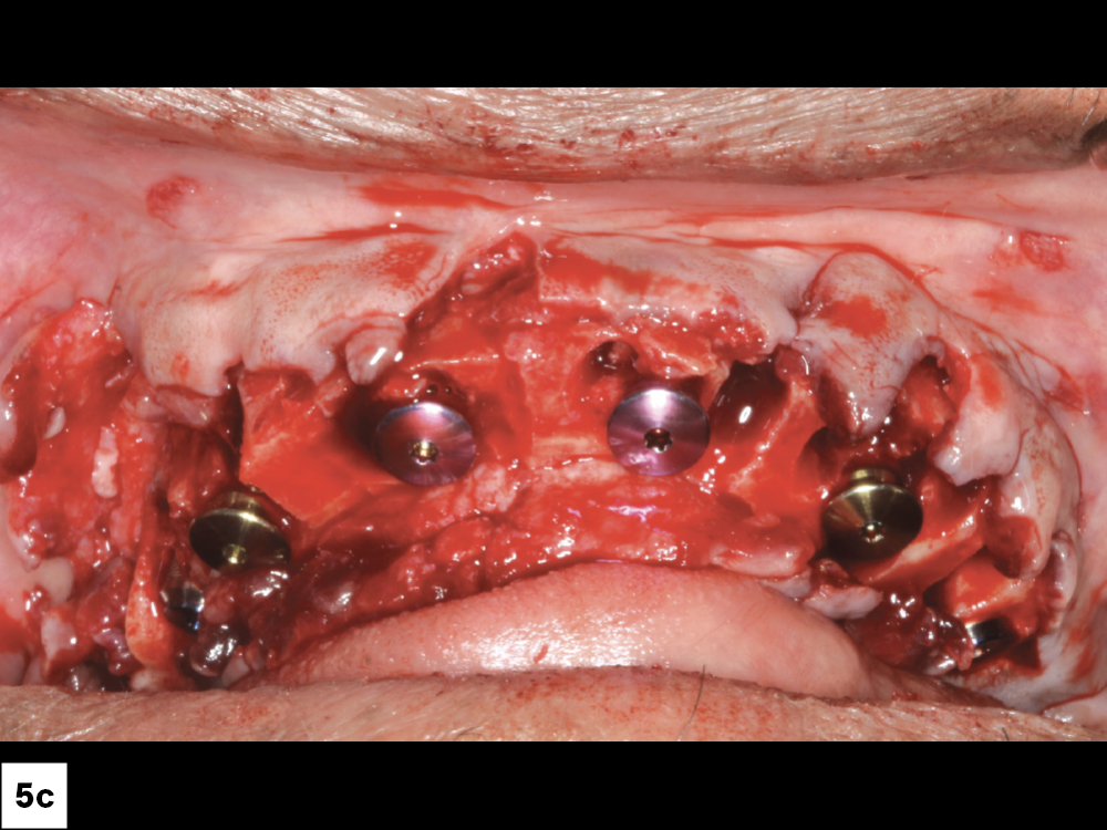 Each implant was placed at a torque of 25 Ncm. I then threaded 3-mm-tall healing abutments into place, according to the digital treatment plan provided by the team at Glidewell.