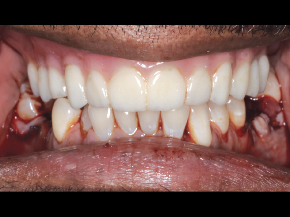 After closing the site, I seated a 3D-printed immediate denture relined with Mucopren® reline material (Kettenbach; Huntington Beach, Calif.).