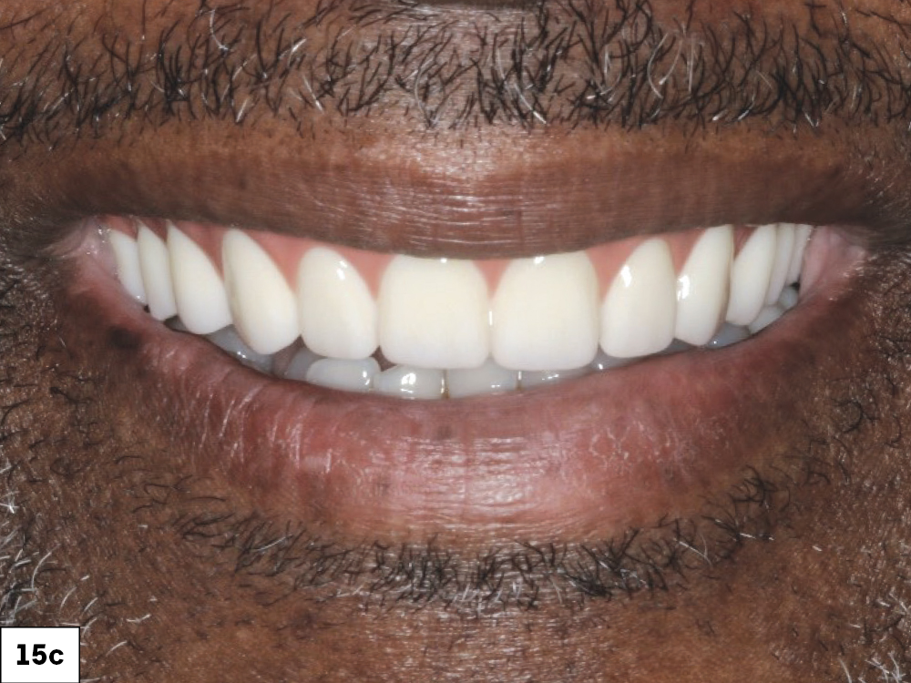 The full-arch implant restoration met the patient’s expectations for esthetics, form and function to improve his quality of life.