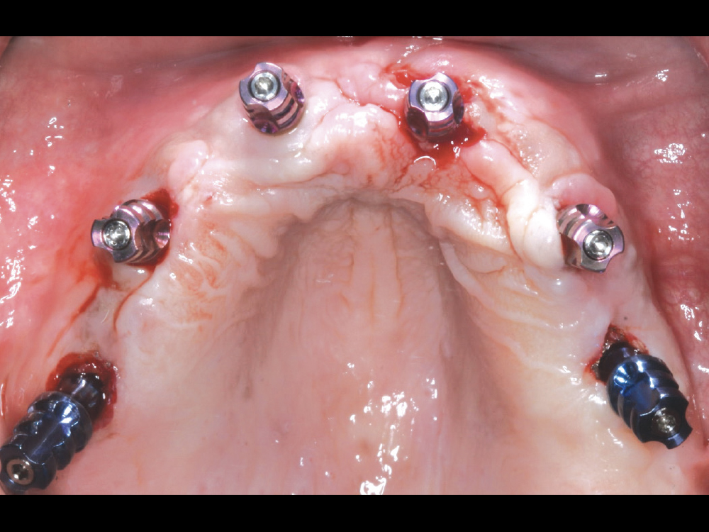 After a four-month period for healing and osseointegration, the tissue that healed over some of the implant sites was removed using a No. 8 round bur while ensuring maintenance of attached gingiva.