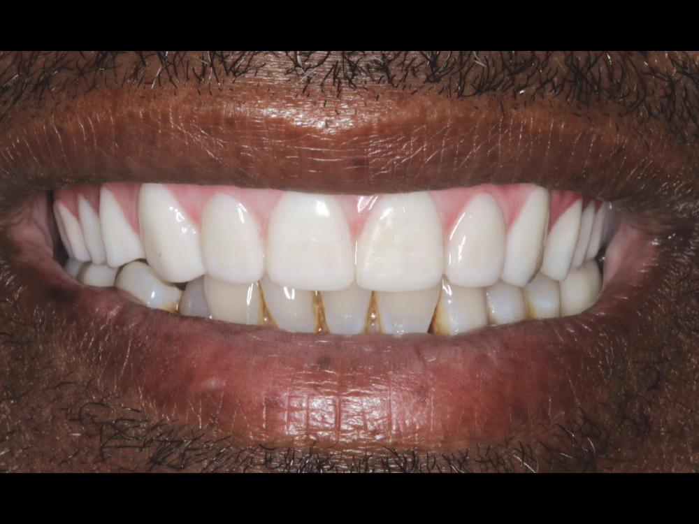 No changes to the design were indicated, so the final BruxZir Implant Prosthesis was delivered during the next visit. Final adjustments were made, and the screw access holes were sealed with Teflon tape and composite.