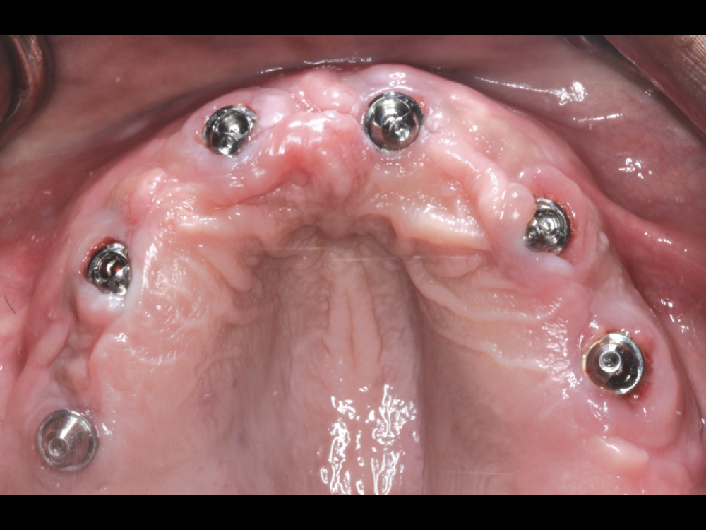 Glidewell technicians chose the multi-unit abutments and angulations for ideal access-hole positioning with the final prosthesis.