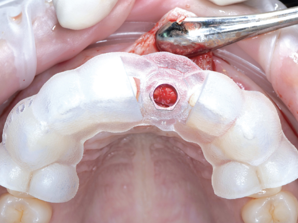 Teeth provide stability and retention to tooth-supported guides allowing precise placement of single or multiple implants. If there are sufficient remaining stable teeth, these guides provide the greatest surgical accuracy.