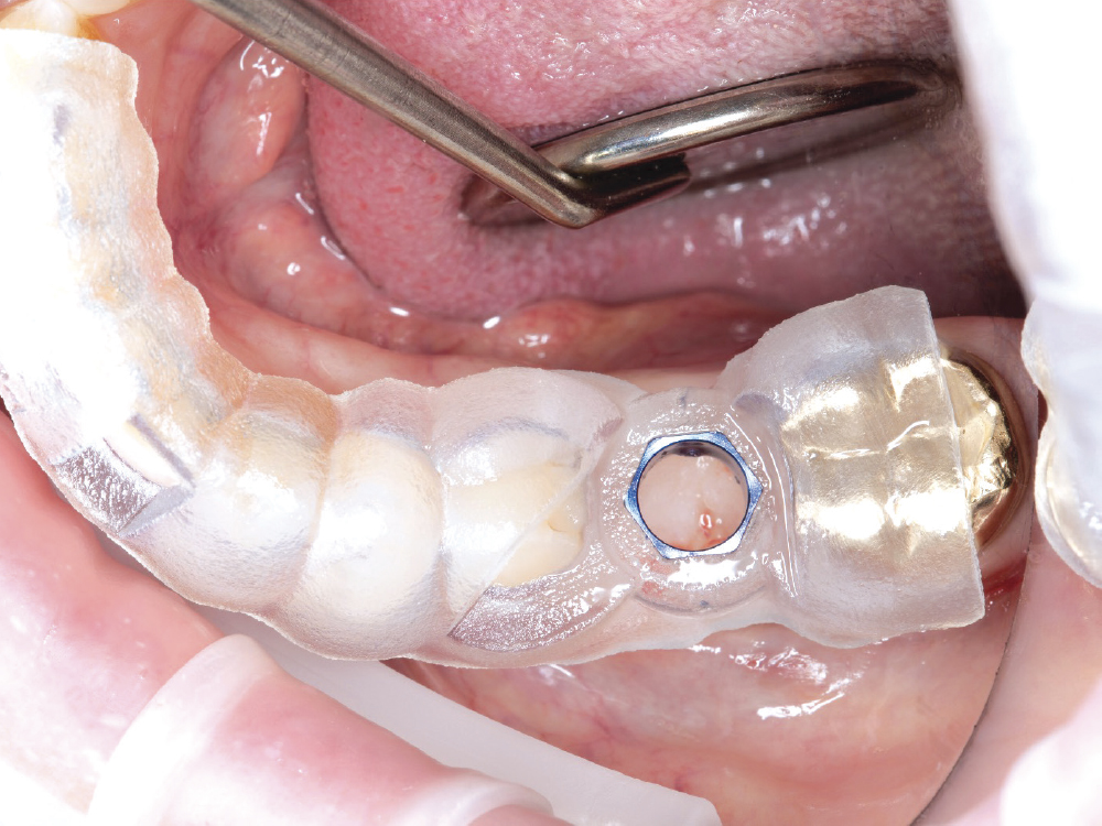 Teeth provide stability and retention to tooth-supported guides allowing precise placement of single or multiple implants. If there are sufficient remaining stable teeth, these guides provide the greatest surgical accuracy.